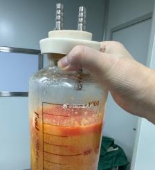 东平水动力吸脂手术要做多久？